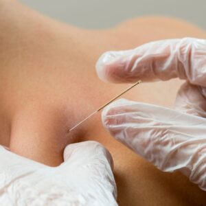 Dry needling